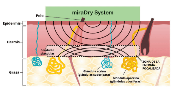 miraDry - Sudoración excesiva