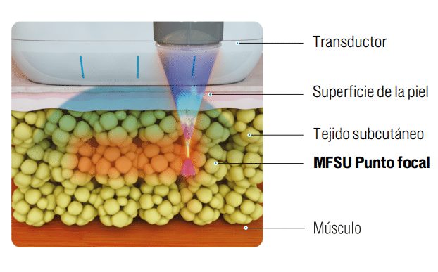 Scizer - HIFU macrofocalizado