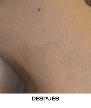 MeDioStar láser depilación