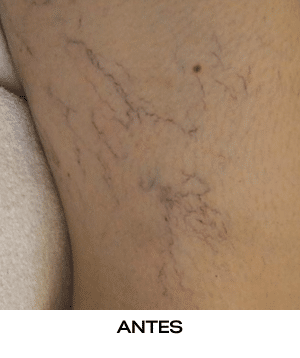 MeDioStar láser depilación