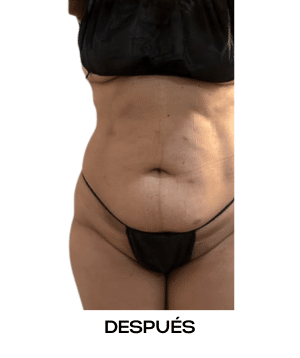 Velas II - Láser Diodo