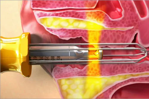 Láser eCO2 resurfacing de CO2