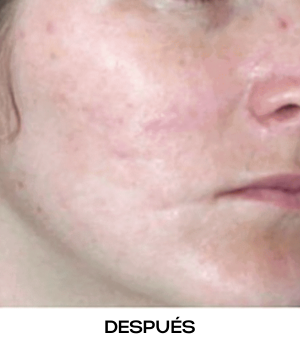 Láser eCO2 resurfacing de CO2