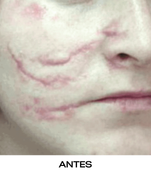 Láser eCO2 resurfacing de CO2