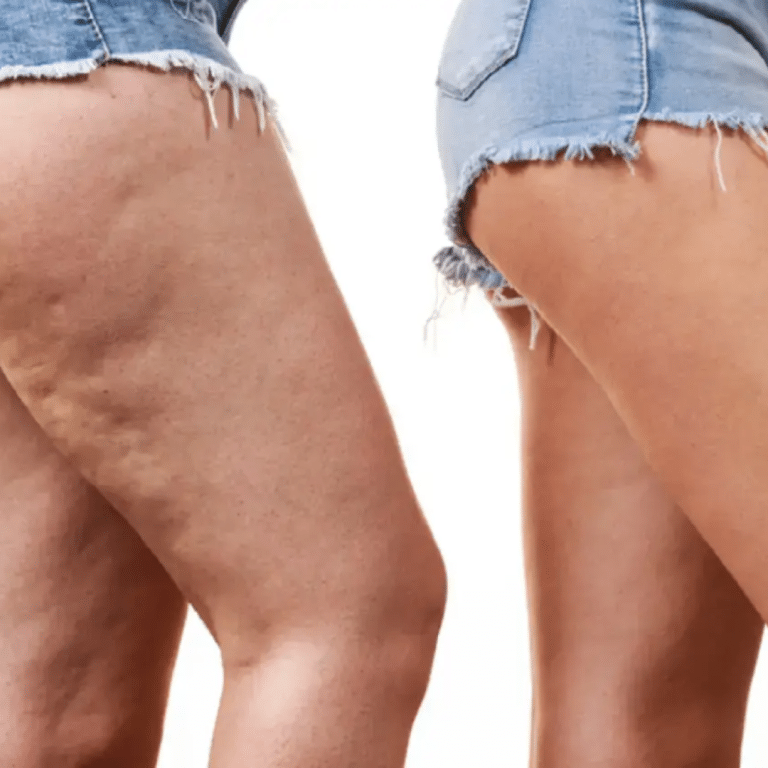 Congreso de lipedema