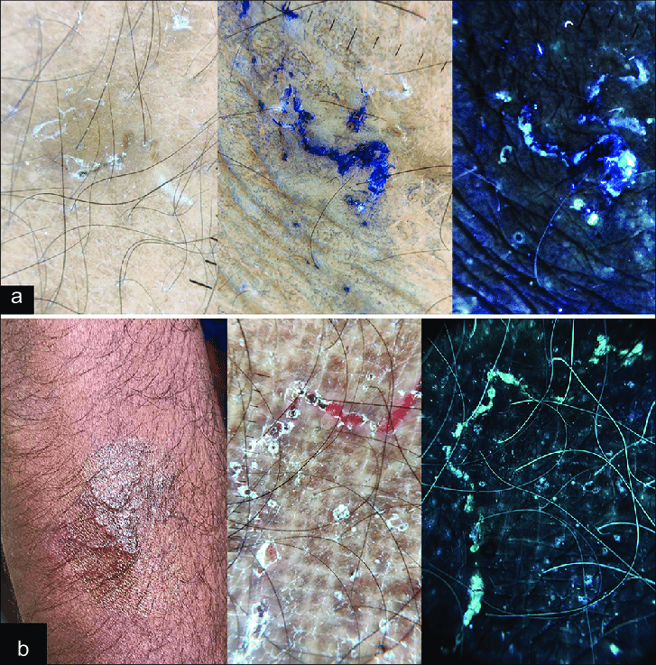 Dermatoscopio DermLite DL5