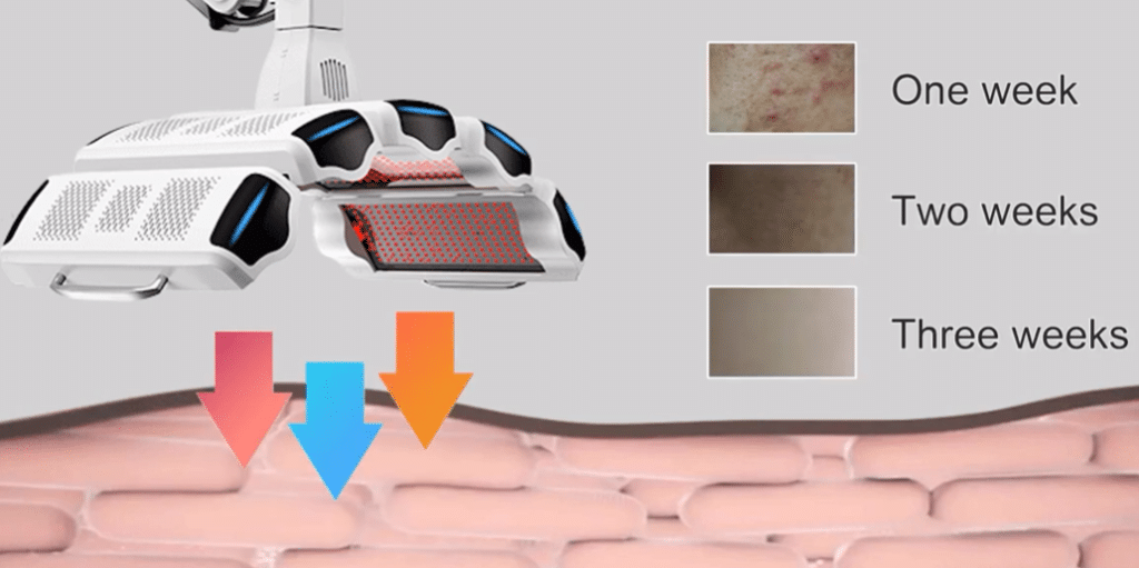 Terapia fotodinámica con luz LED roja