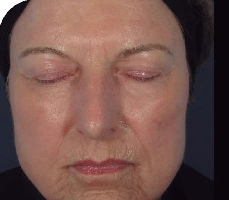 Antes del tratamiento con AcuPulse: rejuvenecimiento facial