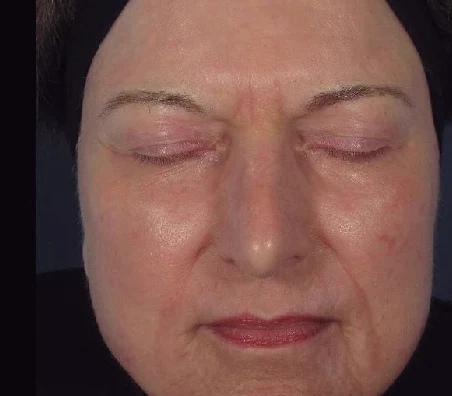 Después del tratamiento con AcuPulse: rejuvenecimiento facial