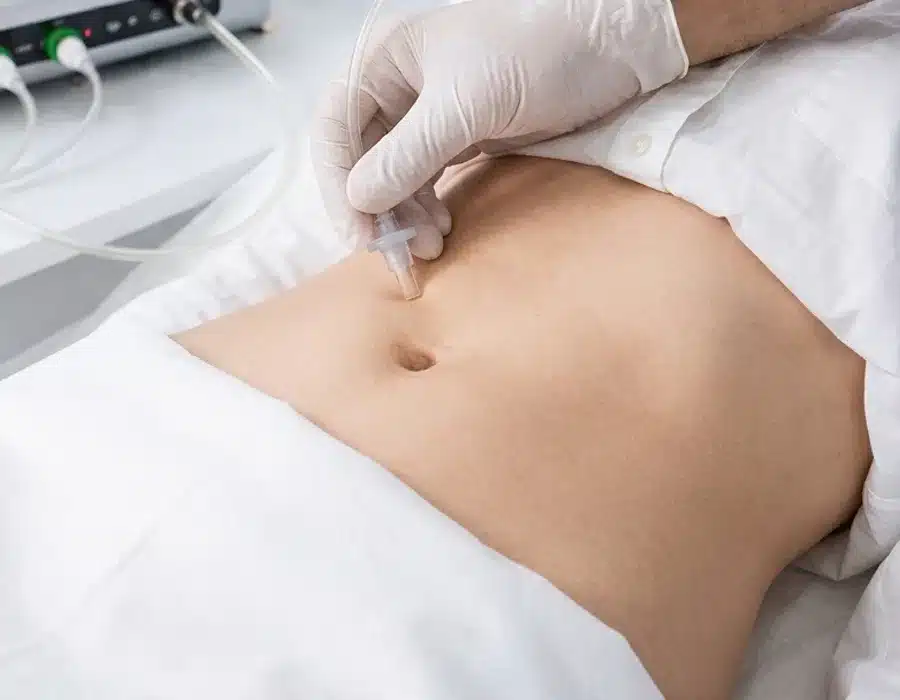 Aplicación de carboxiterapia en el abdomen con Carbocell