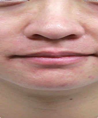 Antes del tratamiento con Cellec V: enrojecimiento facial