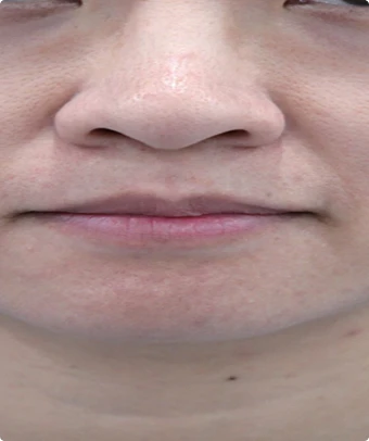 Después de 4 semanas de tratamiento con Cellec V: enrojecimiento facial