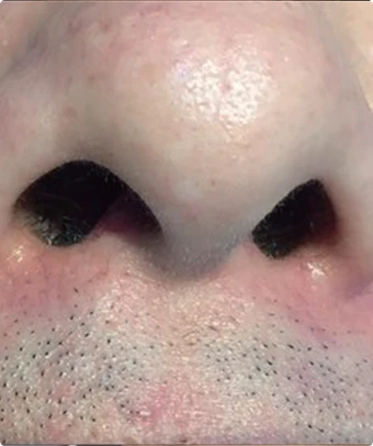 Después de 4 semanas de tratamiento con Cellec V: telangiectasias faciales