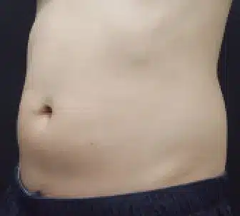 Abdomen antes del tratamiento con CLATUU Alpha