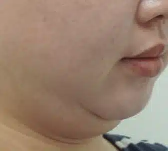 Doble mentón antes del tratamiento con CLATUU Alpha