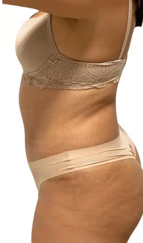 Contorno abdominal antes del tratamiento con CLATUU Alpha