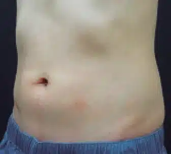 Abdomen tras una sesión con CLATUU Alpha