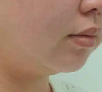 Doble mentón tras una sesión con CLATUU Alpha