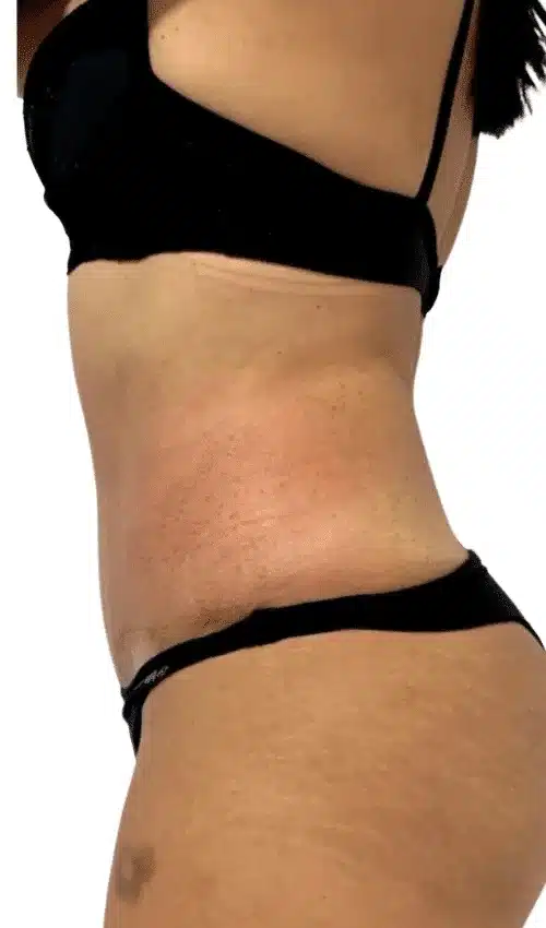 Contorno abdominal después del tratamiento con CLATUU Alpha