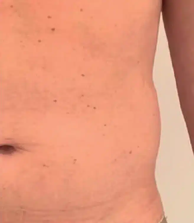 Antes del tratamiento con Deep Slim, abdomen