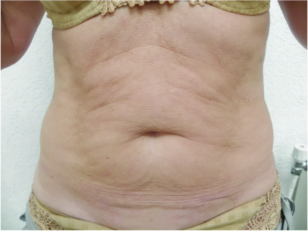 Antes del tratamiento con ENDYMED PRO: abdomen