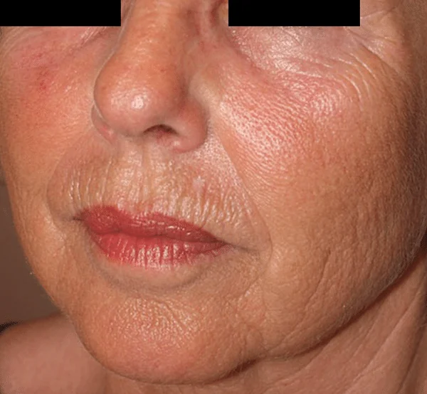 Antes del tratamiento con ENDYMED PRO: arrugas faciales