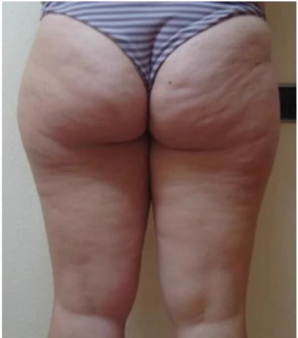 Antes del tratamiento con ENDYMED PRO: celulitis