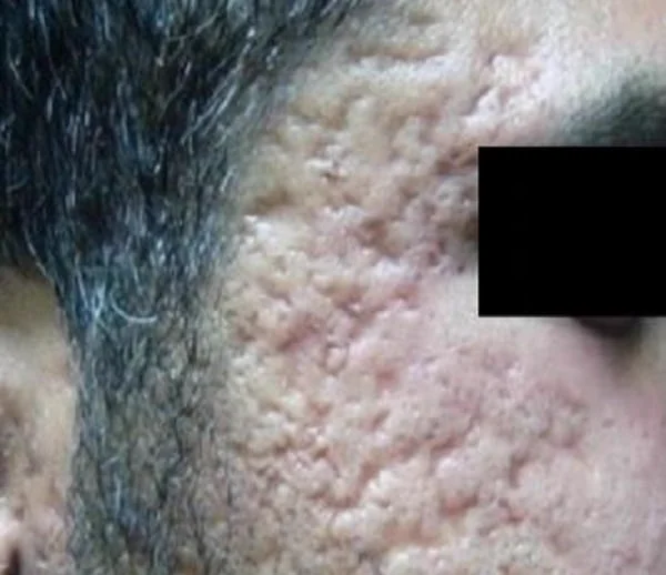 Antes del tratamiento con ENDYMED PRO: cicatrices de acné