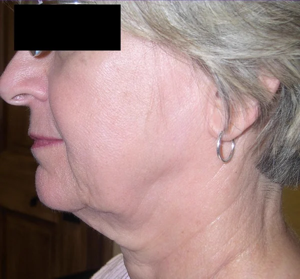 Antes del tratamiento con ENDYMED PRO: cuello y mandíbula