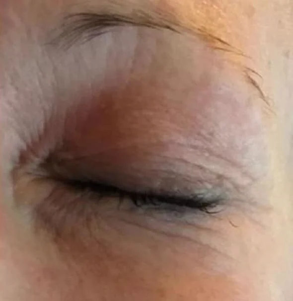 Antes del tratamiento con ENDYMED PRO: contorno de ojos