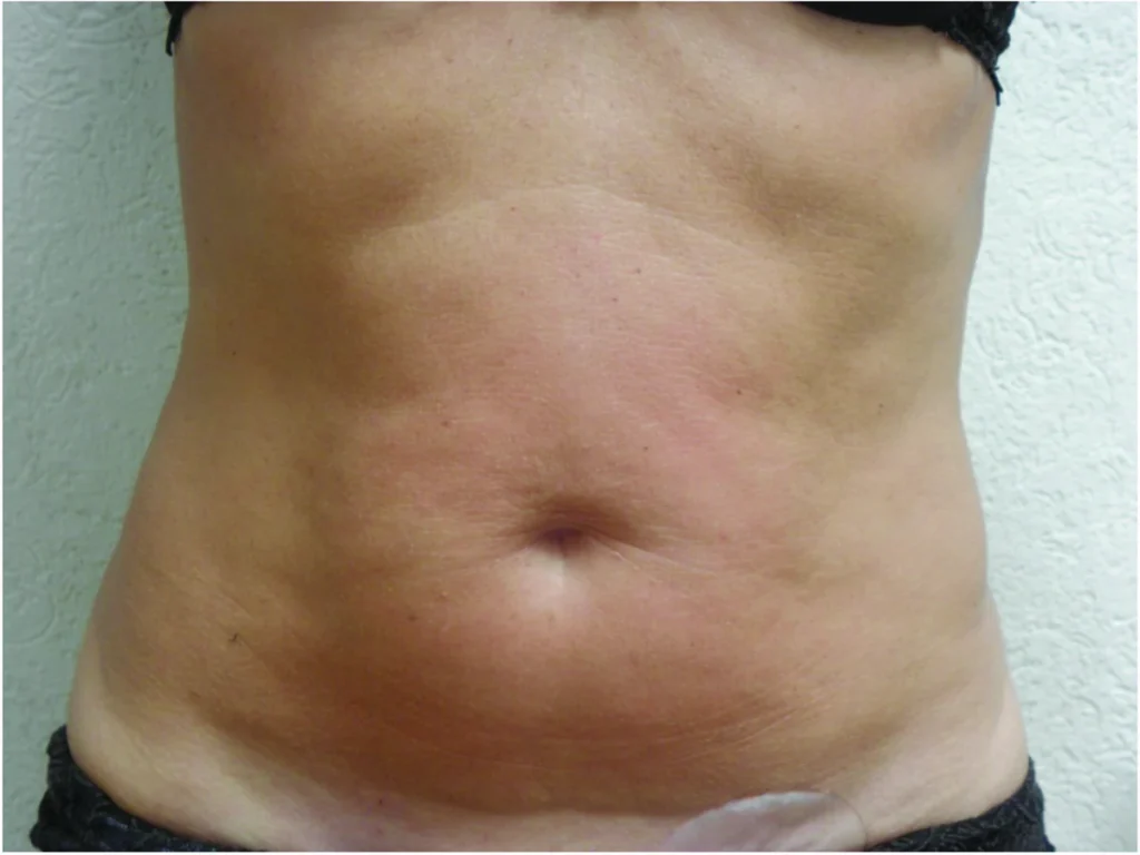 Después del tratamiento con ENDYMED PRO: abdomen
