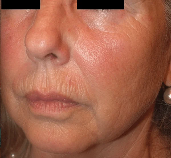 Después del tratamiento con ENDYMED PRO: arrugas faciales
