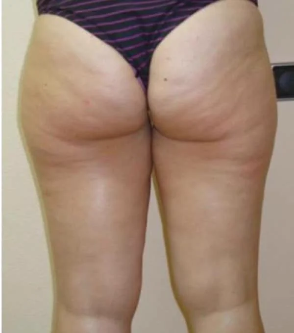 Después del tratamiento con ENDYMED PRO: celulitis