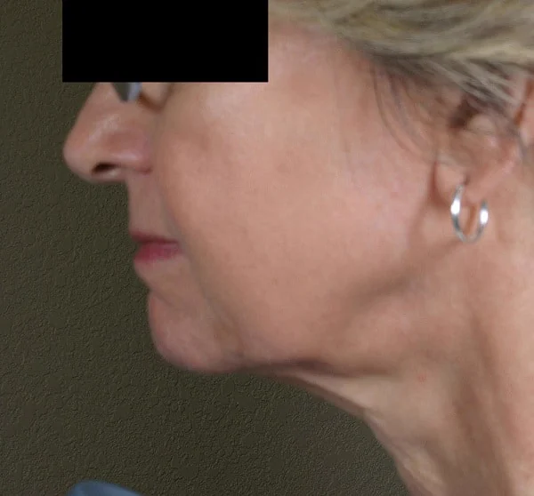 Después del tratamiento con ENDYMED PRO: cuello y mandíbula