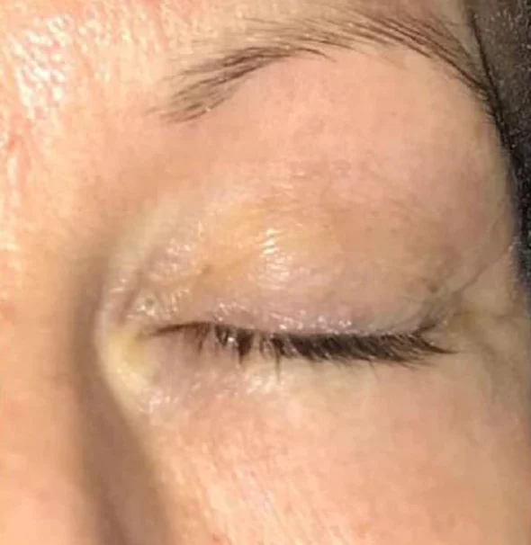 Después del tratamiento con ENDYMED PRO: contorno de ojos
