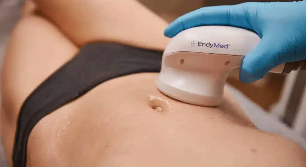 Tratamiento corporal con pieza de mano EndyMed en el abdomen