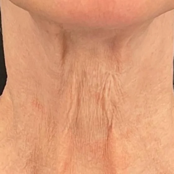 Antes del tratamiento con Genius: cuello