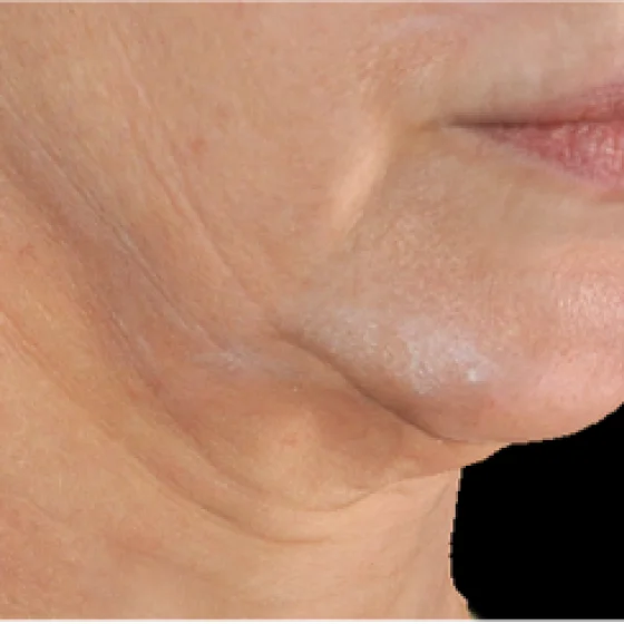 Antes del tratamiento con Genius: línea mandibular