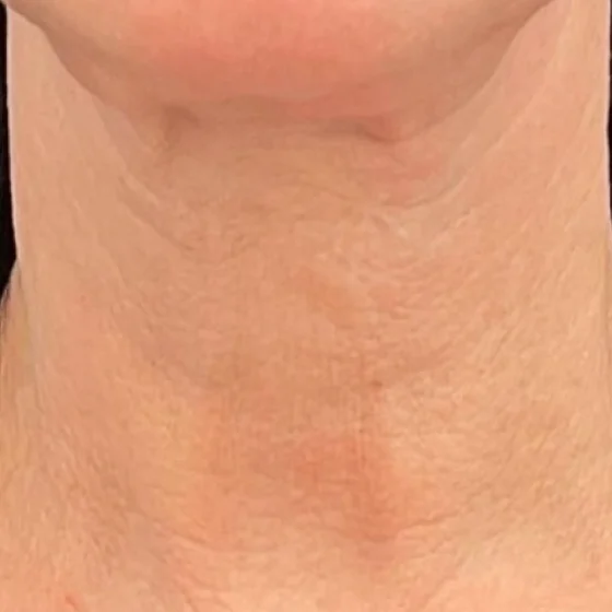 Después del tratamiento con Genius: cuello