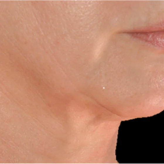 Después del tratamiento con Genius: línea mandibular