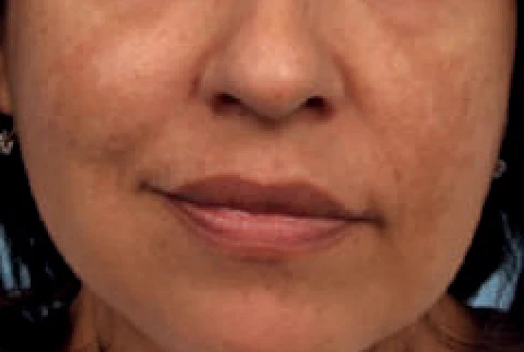 Antes del tratamiento con Hollywood Spectra: melasma