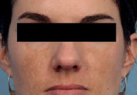 Antes del tratamiento con Hollywood Spectra: melasma