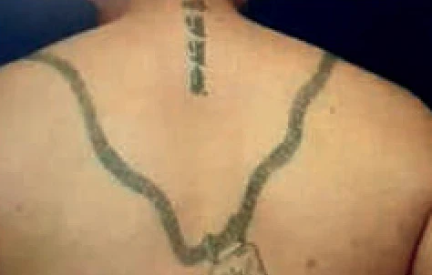 Antes del tratamiento con Hollywood Spectra: eliminación de tatuaje