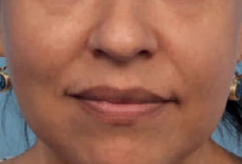 Después del tratamiento con Hollywood Spectra: melasma