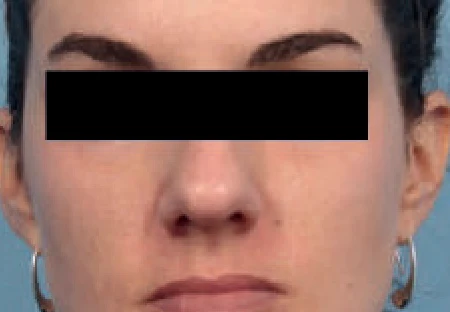 Después del tratamiento con Hollywood Spectra: melasma