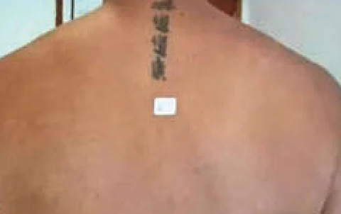 Después del tratamiento con Hollywood Spectra: eliminación de tatuaje
