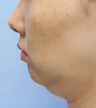 Antes del procedimiento con Liposound: mandibula