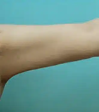 Después del procedimiento con Liposound: brazo