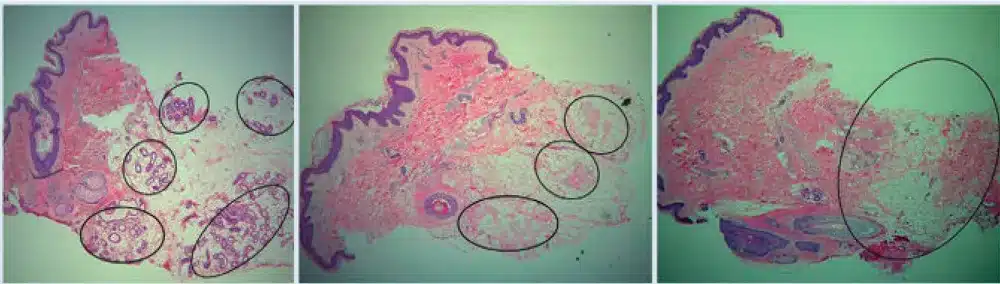 Histología de glándulas sudoríparas antes y después de miraDry