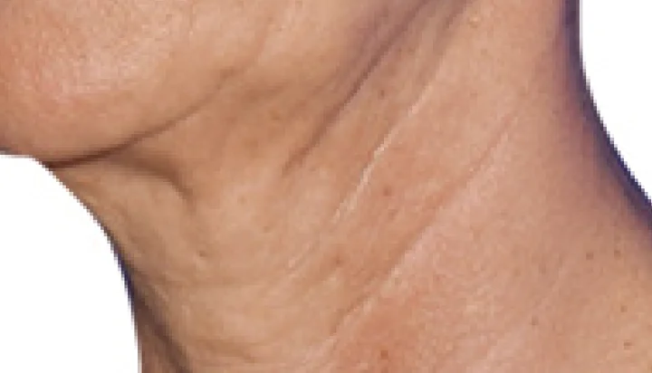 Arrugas del cuello antes del tratamiento